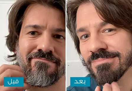 Mustache & Beard before & after