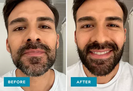 Moustache & Beard Before & After