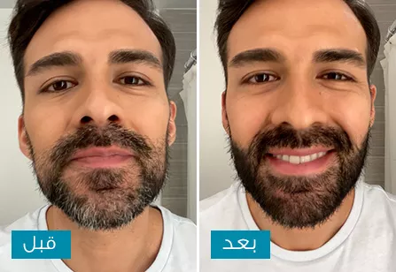 Mustache & Beard before & after