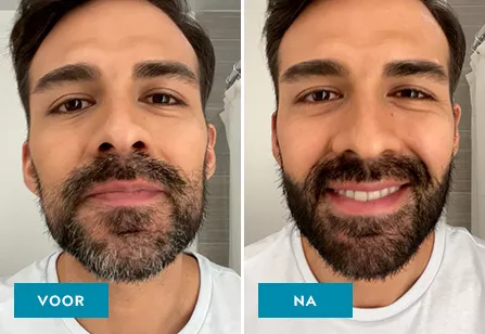 Mustache & Beard before & after